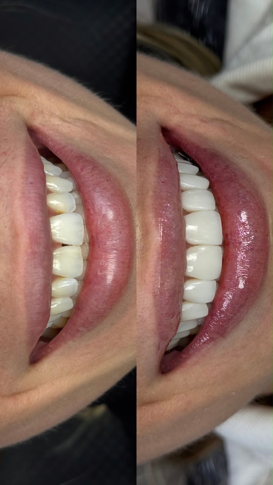 Antes e depois de lentes em resina
